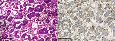 Construction and validation of a nomogram for predicting the prognosis of patients with lymph node-positive invasive micropapillary carcinoma of the breast: based on SEER database and external validation cohort